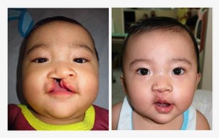 Before & After reconstructive surgery